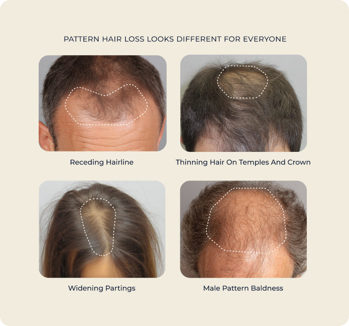 Illustrations of different hair loss patterns on a beige background