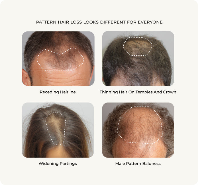 Pattern hair loss